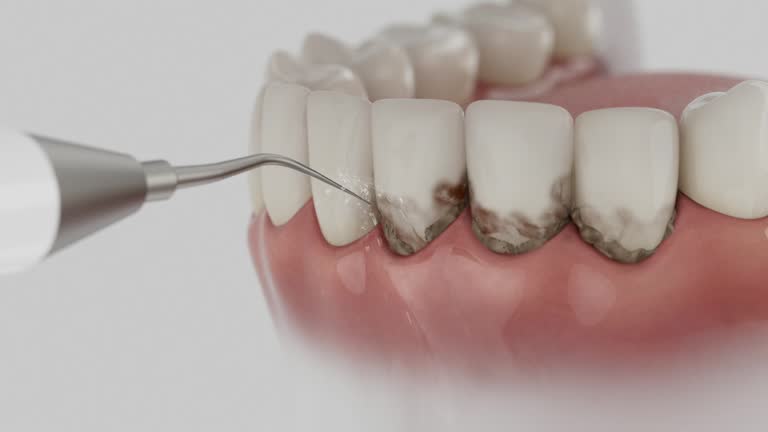 Trusted Wisdom Tooth Removal service in Mountain Brook, AL - Dentist Open Now
